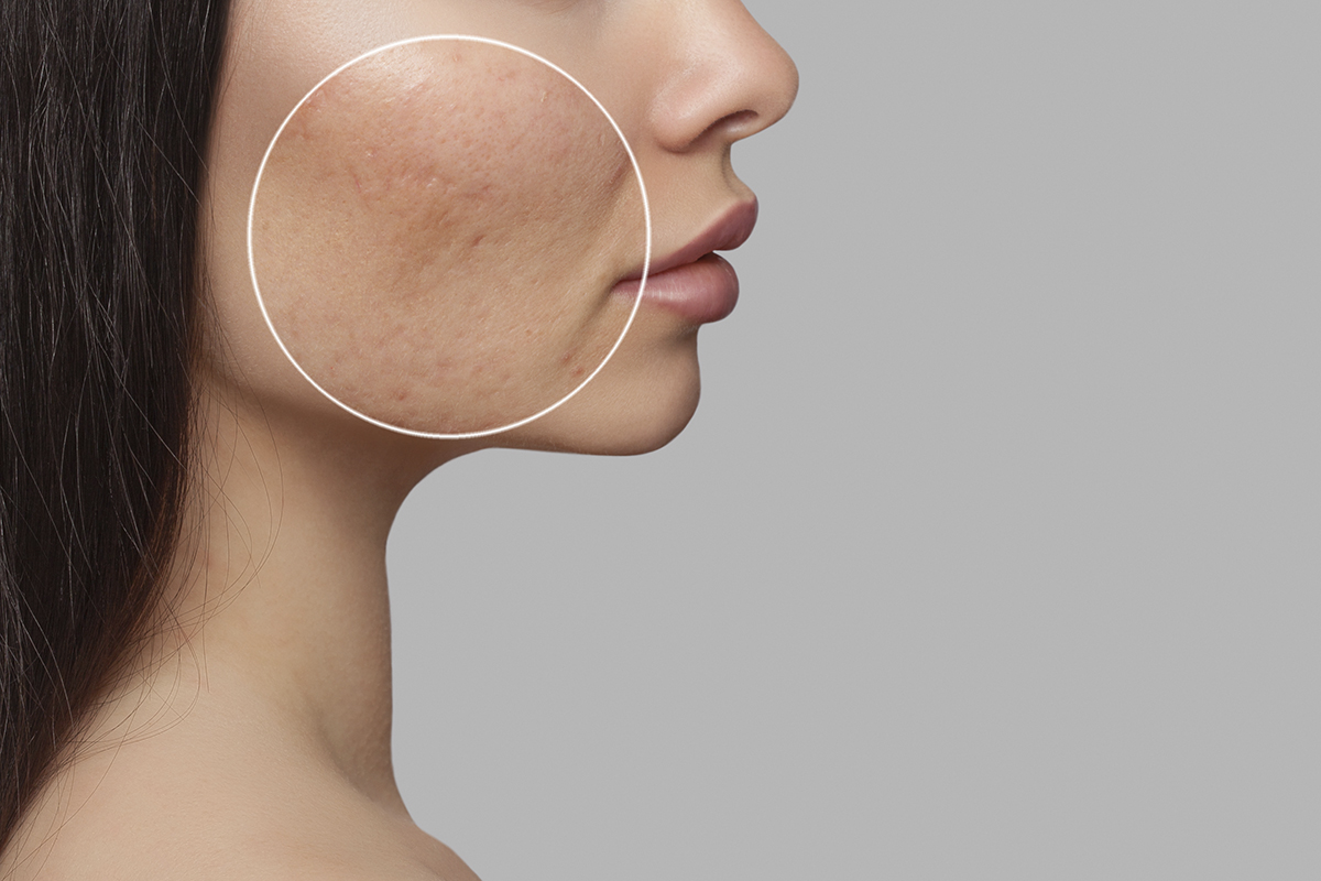 Cicatrizes de acne