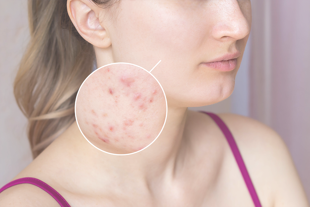 Acne na vida adulta